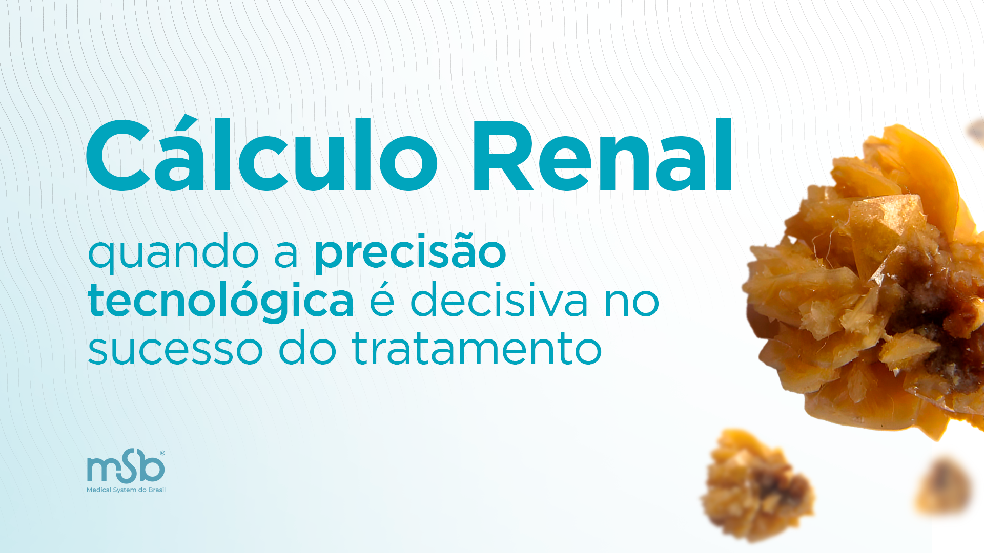 Cálculo Renal: quando a precisão tecnológica é decisiva no sucesso do tratamento