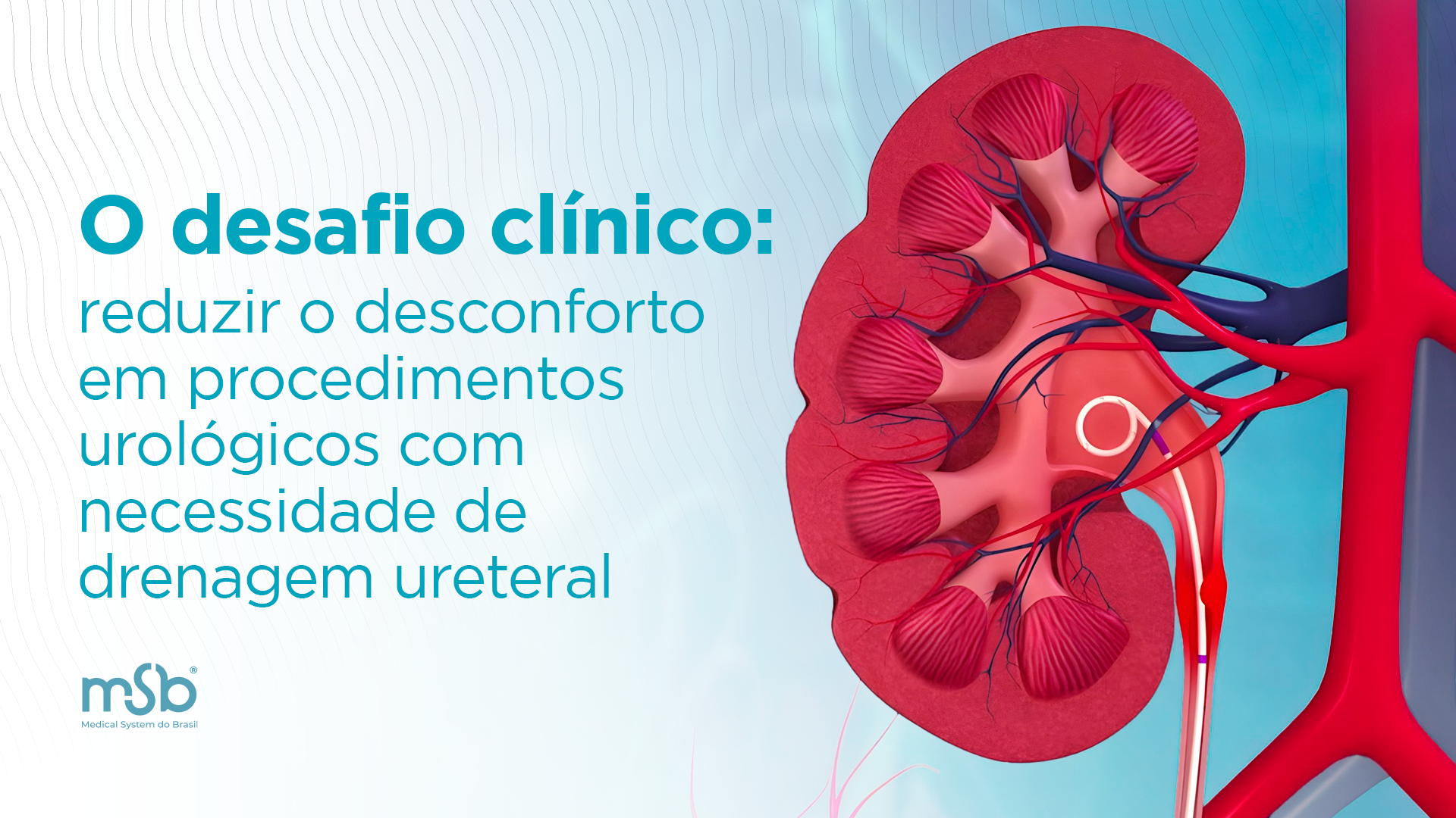 O desafio clínico: reduzir o desconforto em procedimentos urológicos com necessidade de drenagem ureteral